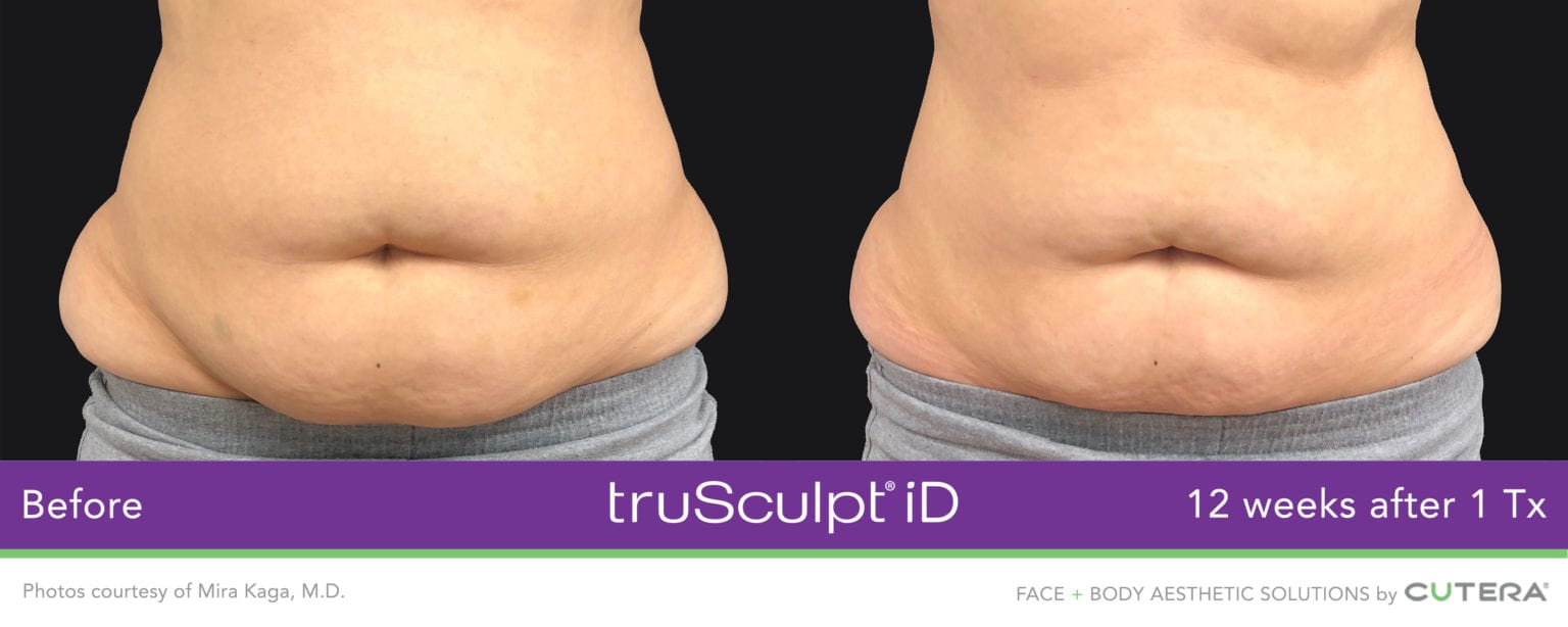 Why Trusculpt ID out performs Coolsculpting